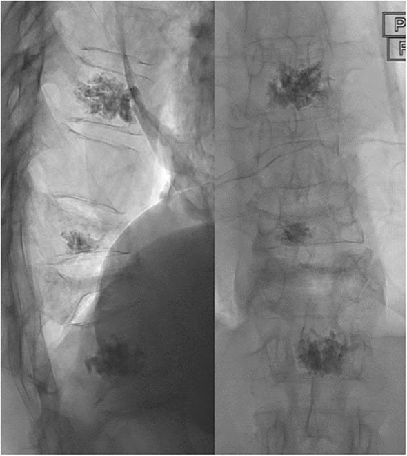 AP and lateral fluoroscopic images after multilevel vertebroplasty for painful myeloma vertebral fractures.