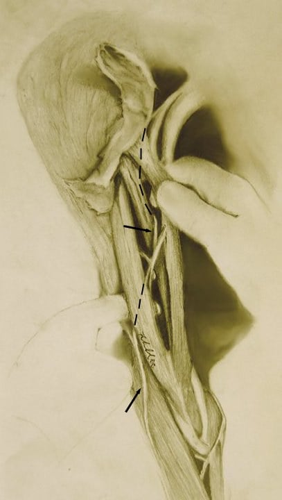 Cadaveric dissection of the anterior arm tracing the path of the musculocutaneous nerve (dashed line, arrows) descending between biceps and brachialis.