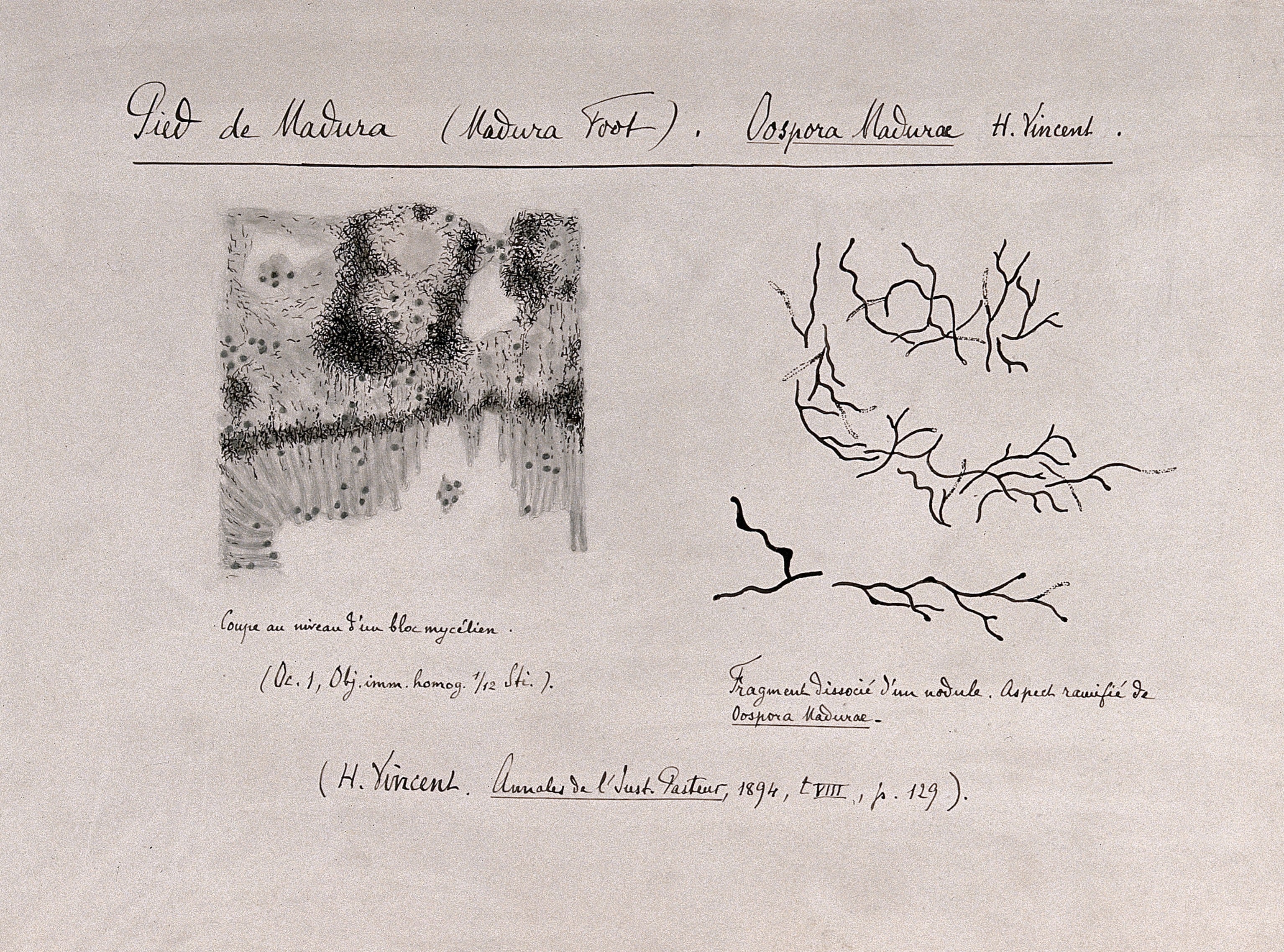 Historical drawing of the microscopic appearance of grains from a foot affected by mycetoma.