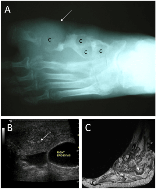 Composite figure with a foot radiograph showing soft tissue swelling and large bone cavities, alongside an ultrasound image of scrotal eumycetoma.