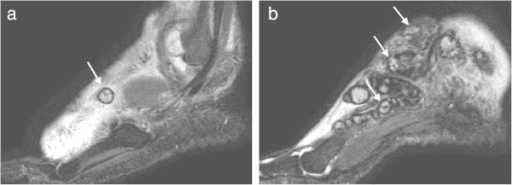 Two sagittal STIR MRI images of a foot with multiple small bright round lesions separated by dark rims.