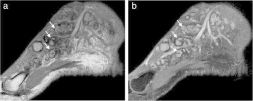 Sagittal T1-weighted MRI of a foot with multiple lesions containing small dark central dots and dark surrounding rims.