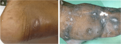 Two clinical photographs of a foot showing swelling and multiple discharging skin sinuses, one posterior and one dorsal with pigmented crusting.