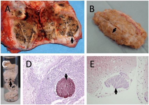 Photographs of surgically obtained mycetoma grains of differing colour and size, including black grains.