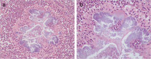 Two histology slides stained pink and purple showing bacterial colonies surrounded by inflammatory cells.