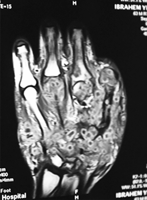 MRI of a foot showing soft tissue and bone lesions with small central dots inside ring-like areas.