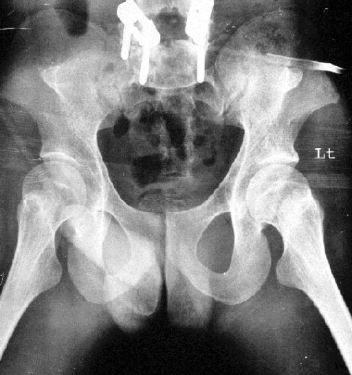 AP pelvis radiograph showing bilateral posterior iliac horns in nail-patella syndrome