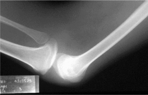 Lateral knee radiograph showing absent patella in nail-patella syndrome