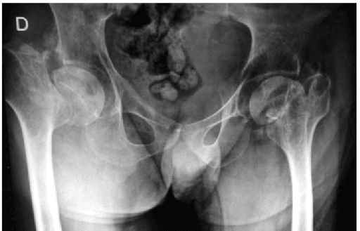 AP pelvis showing bilateral Garden IV femoral neck fractures