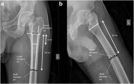 2-panel preoperative hip measurements for surgical planning