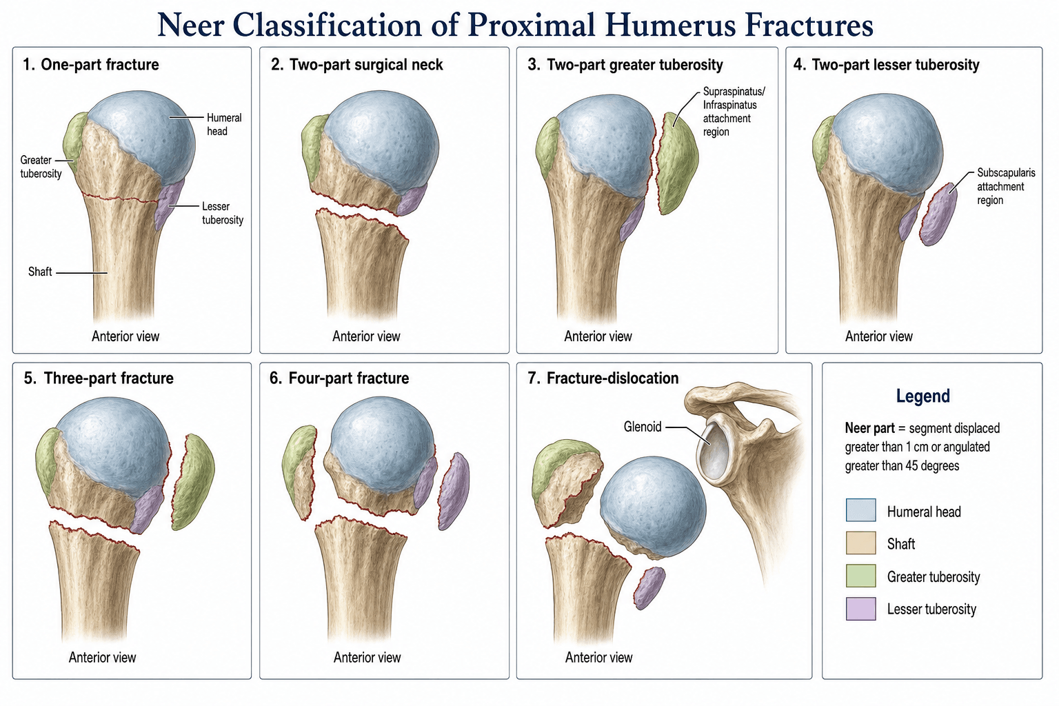 Neer classification of proximal humerus fractures: one-part, two-part (surgical neck, greater tuberosity, lesser tuberosity), three-part, four-part and fracture-dislocation, colour-coded by Codman part