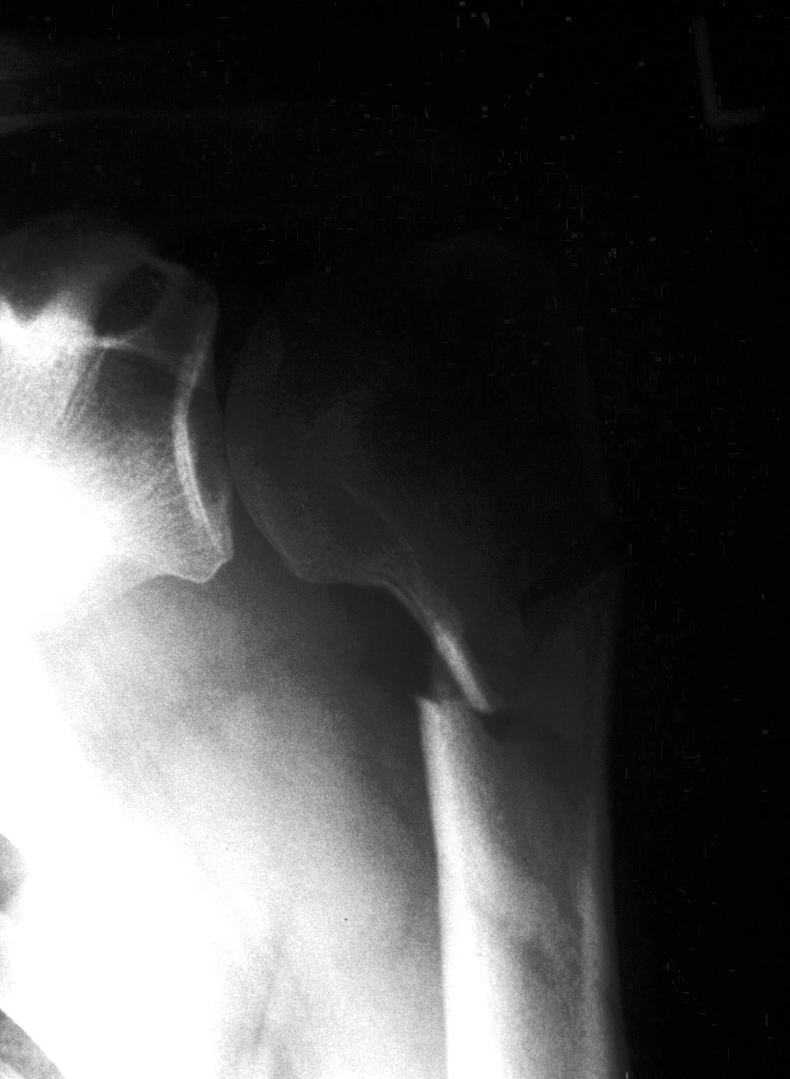 AP shoulder radiograph of a displaced proximal humerus fracture at the surgical neck.