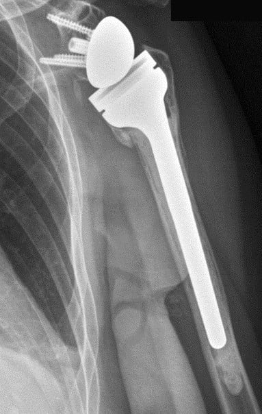 AP shoulder radiograph one year after reverse shoulder arthroplasty, showing the glenosphere fixed to the glenoid and the humeral stem with its concave cup.