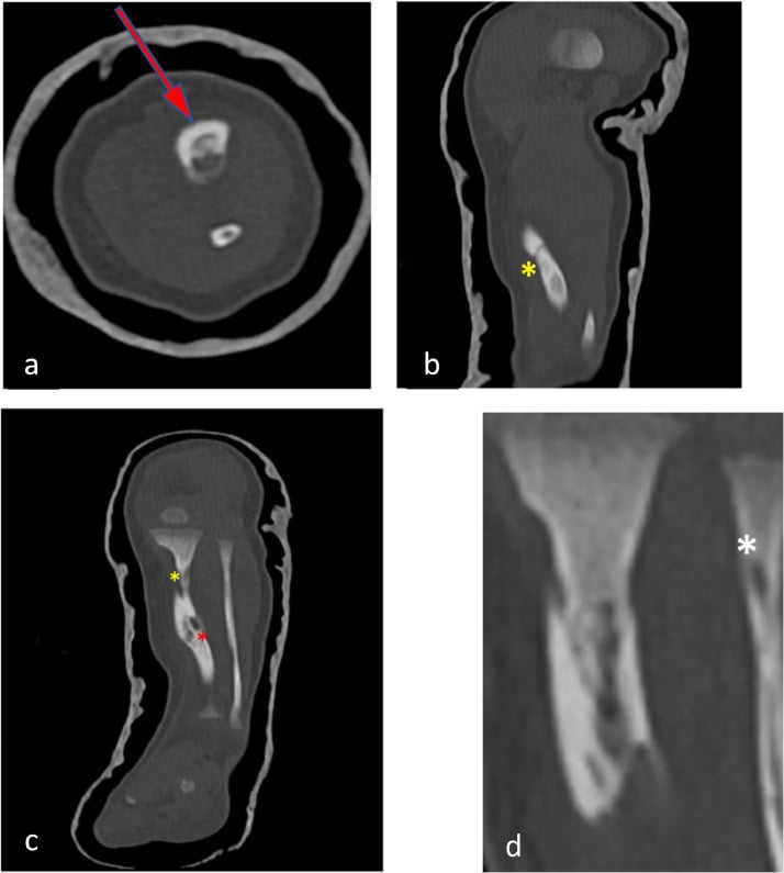 Four-panel CT of a dysplastic tibia in congenital pseudarthrosis, cross-sectional and longitudinal images, with an arrow and asterisks marking the abnormal cortex