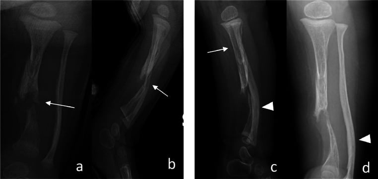 Serial radiographs (a-d) showing progressive tibial pseudarthrosis and bowing