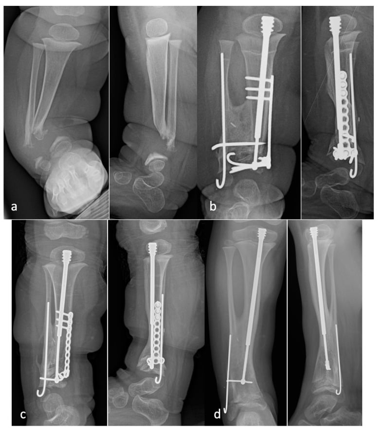 Serial radiographs of tibiofibular cross-union with intramedullary and plate fixation