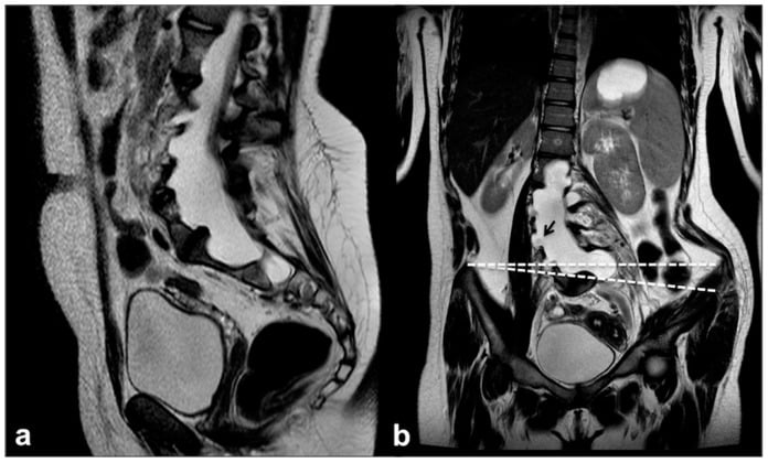 Sagittal and coronal MRI of the lumbosacral region showing a large dural meningocele
