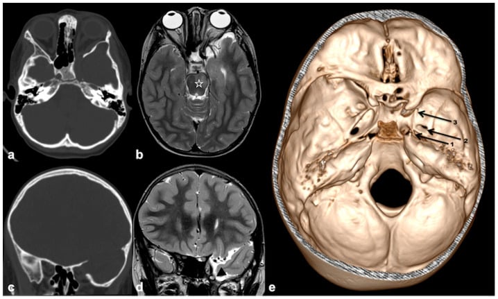 Axial and coronal CT, axial and coronal MRI, and a three-dimensional skull-base reconstruction of sphenoid wing dysplasia in NF1