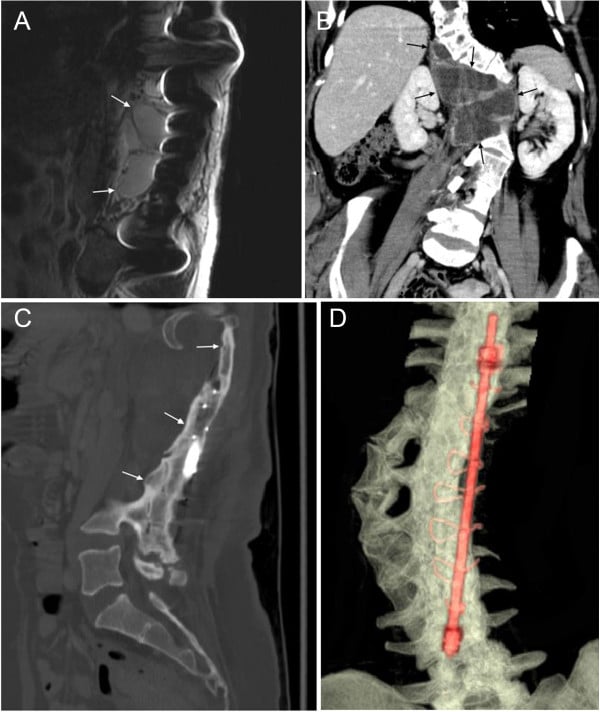 MRI, contrast CT, CT and a volume rendering showing paraspinal neurofibromas, vertebral dysplasia and a spinal rod construct