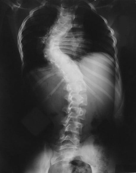 Frontal radiograph of a short, sharply angulated dystrophic thoracic scoliosis in NF1