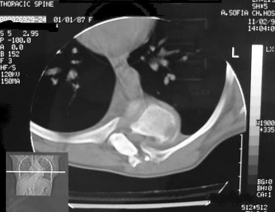 Axial CT of the thoracic spine showing a rib head within the spinal canal in dystrophic NF1 scoliosis