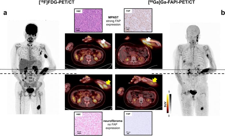 FDG and FAPI PET-CT in NF1 comparing an MPNST, with strong FAP expression, and a neurofibroma, with none