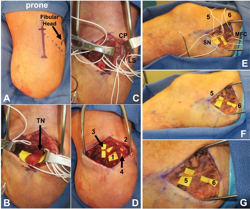 Prone and supine operative sequence for delayed targeted muscle reinnervation after below-knee amputation.