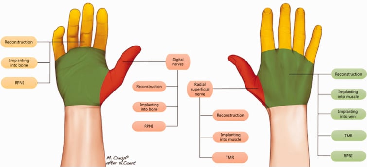 Palmar and dorsal hand maps comparing reconstruction, bone or muscle implantation, RPNI and TMR for painful hand neuromas.