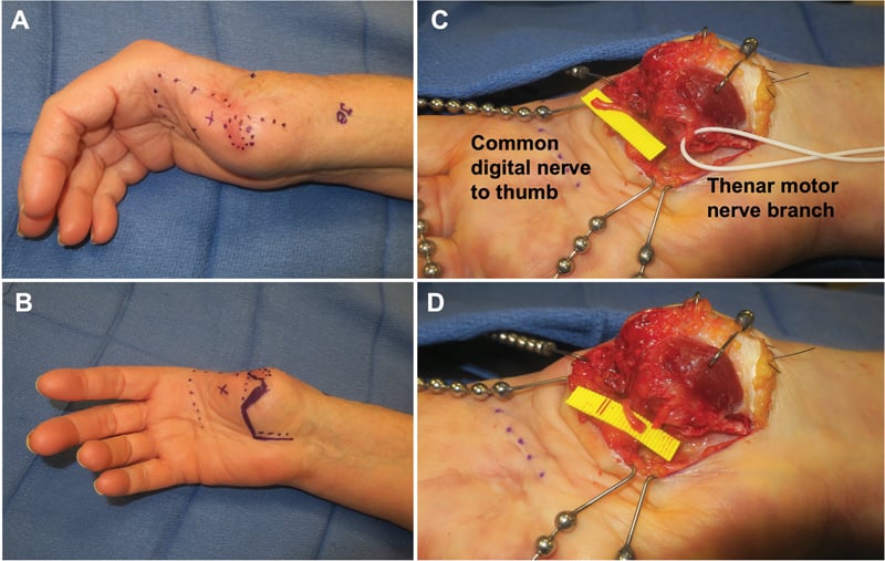 Operative sequence for delayed hand targeted muscle reinnervation using the thumb common digital nerve and thenar motor branch.