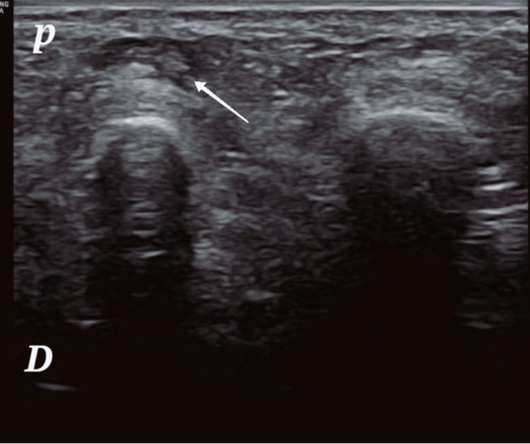 Long-axis ultrasound of a Morton's neuroma with plantar and dorsal orientation marked.