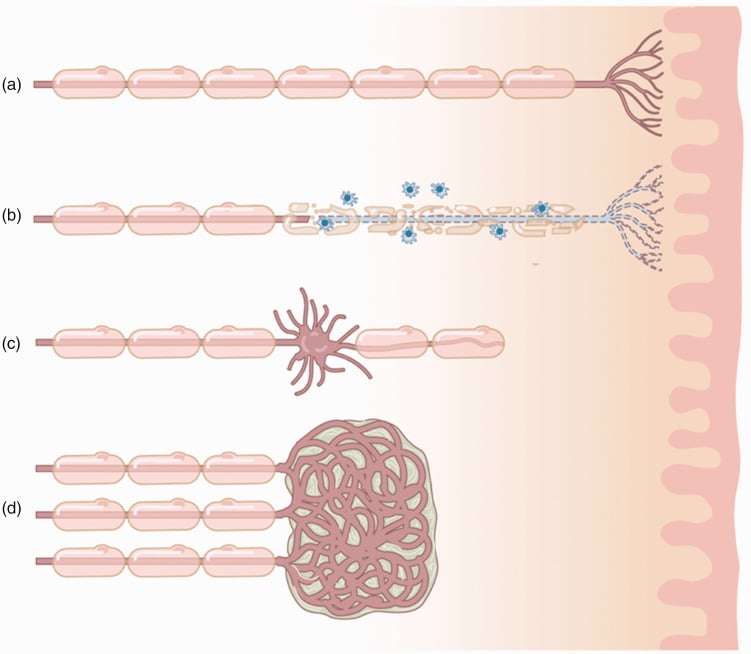 Four-stage schematic of a healthy peripheral nerve, inflammatory myelin injury, neuroma-in-continuity and terminal end-bulb neuroma.