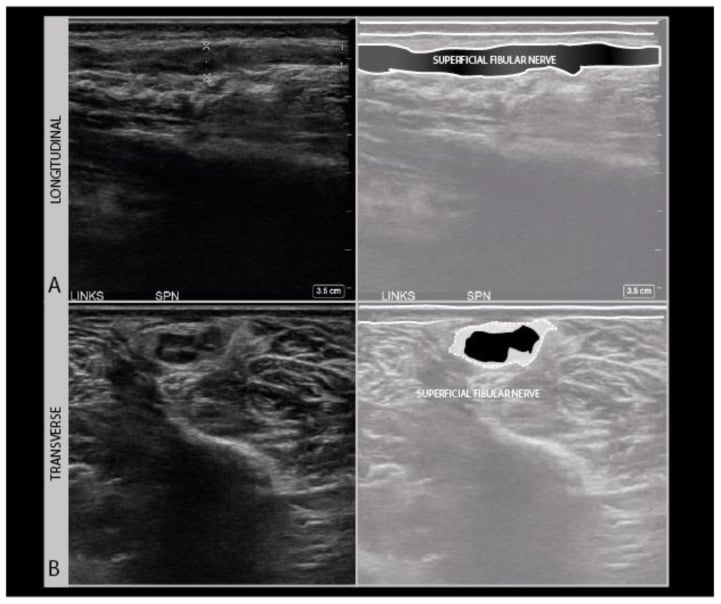 Longitudinal and transverse ultrasound of a disorganised hypoechoic superficial peroneal nerve neuroma.