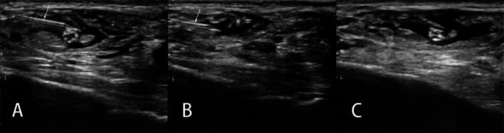 Long-axis and short-axis ultrasound-guided superficial and deep hydrodissection of the sural nerve.