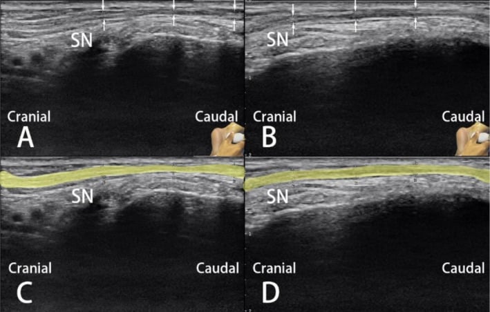 Serial long-axis ultrasound images of the sural nerve before and after ultrasound-guided treatment.