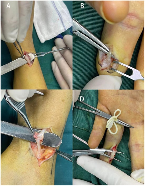 Clinical and operative examples of traumatic neuromas at the radial wrist, middle finger, wrist and index finger.