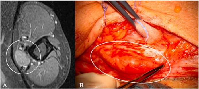 Axial contrast-enhanced MRI and operative view of a fusiform ulnar nerve neuroma at the elbow.