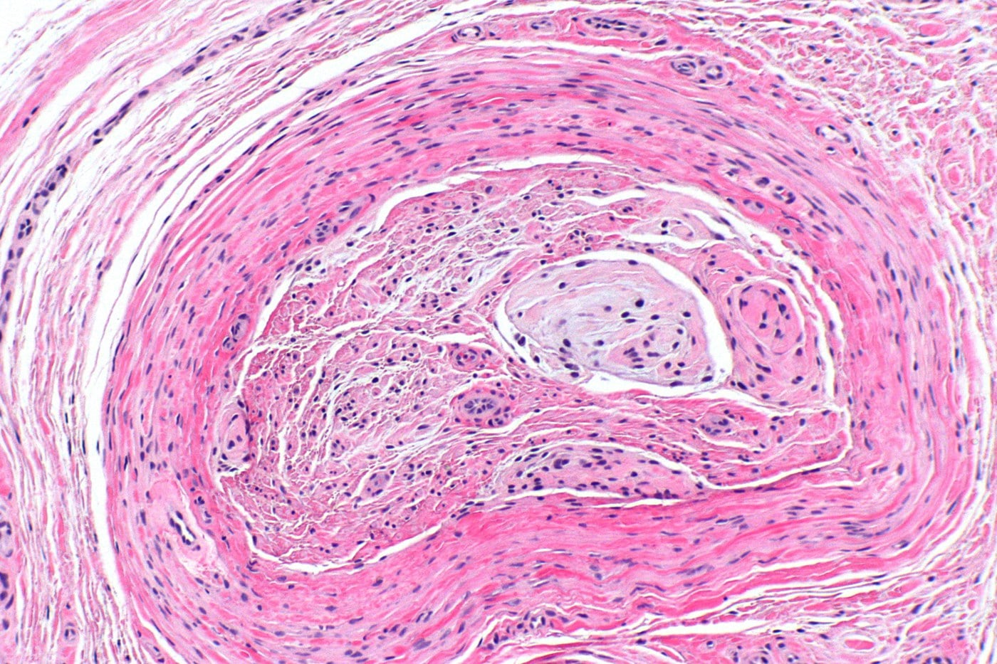 H&E histology of a Morton's (interdigital) neuroma showing concentric perineural fibrosis with whorled hyalinised collagen around the nerve.
