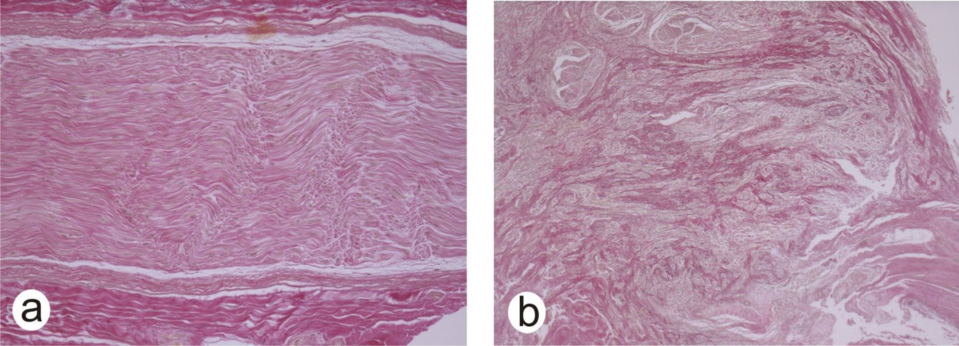 Histology comparing a normal nerve with orderly fascicles (a) to a traumatic neuroma with disorganized whorled nerve bundles (b), Elastica-van-Gieson stain.