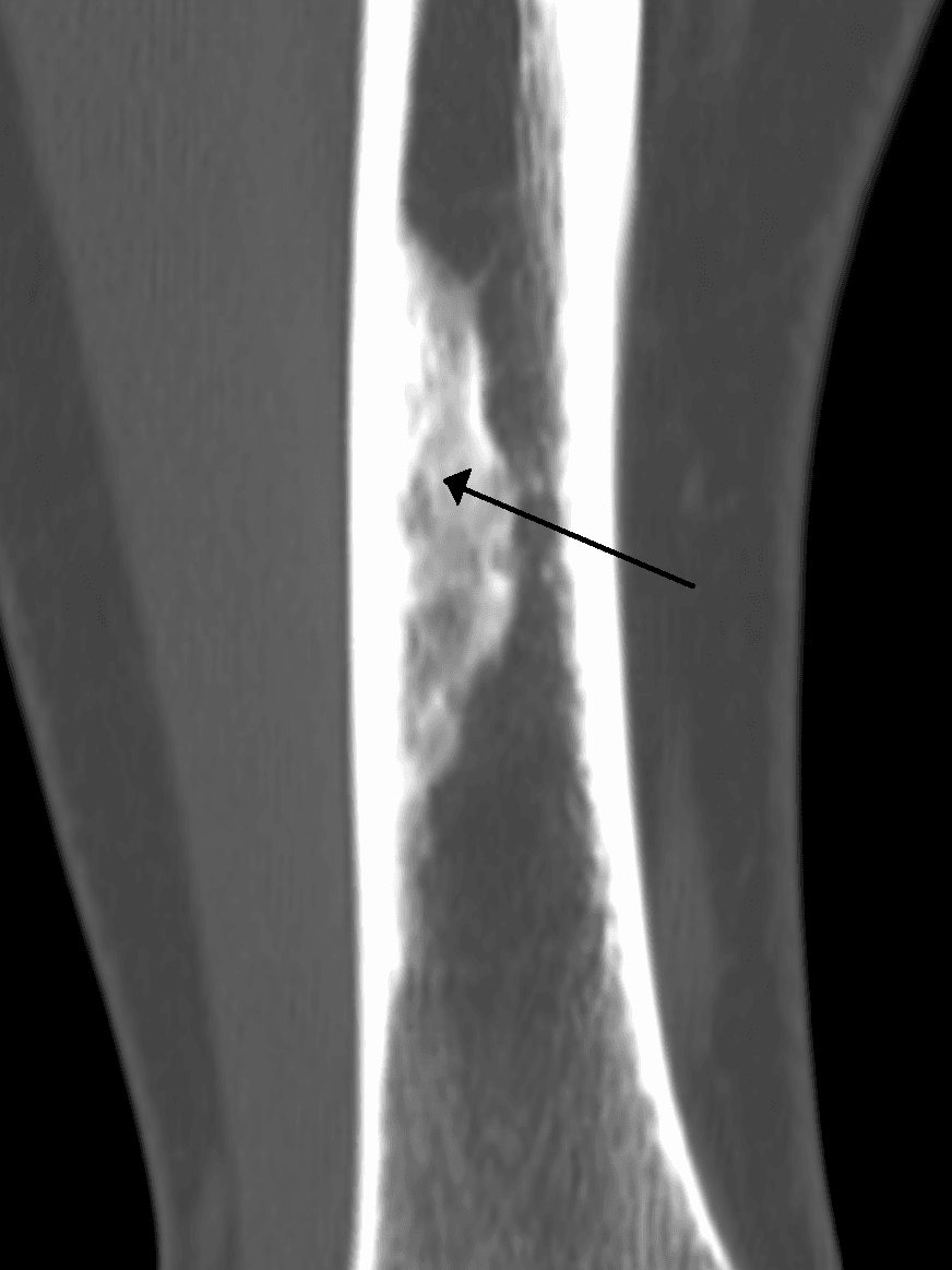 CT of a long bone showing an eccentric, cortically based lucent lesion with a sclerotic margin, a non-ossifying fibroma.