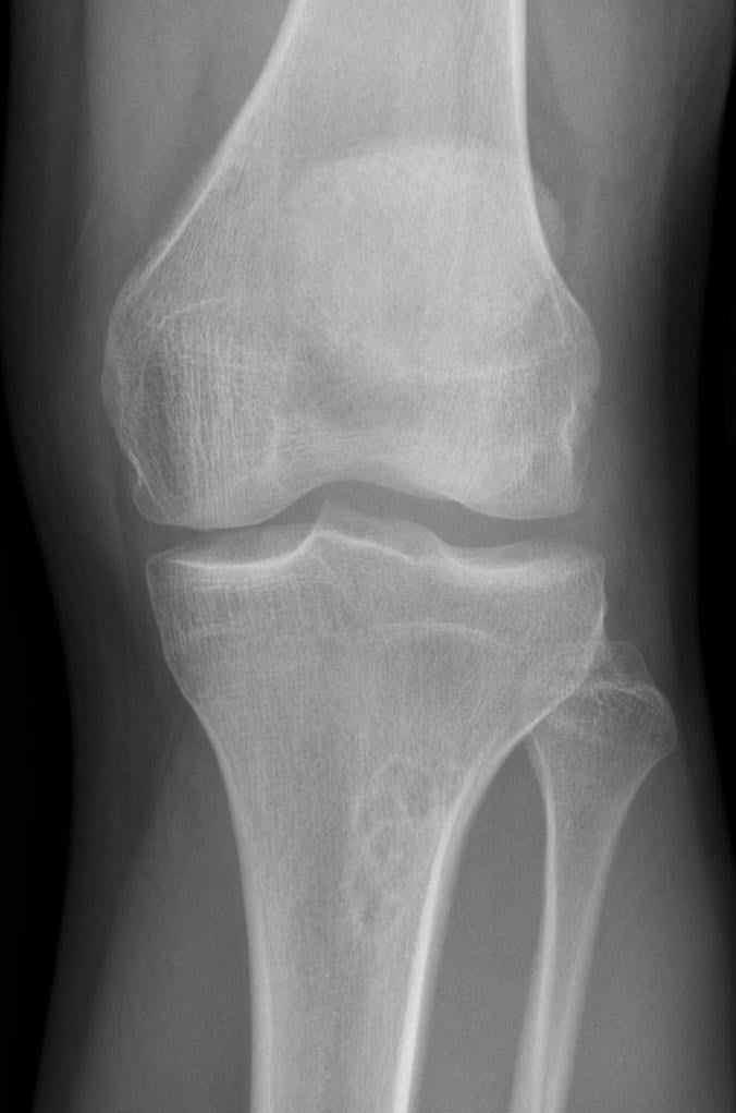 AP knee radiograph of an adolescent showing an eccentric, well-corticated lucent lesion in the proximal tibial metaphysis, a non-ossifying fibroma.