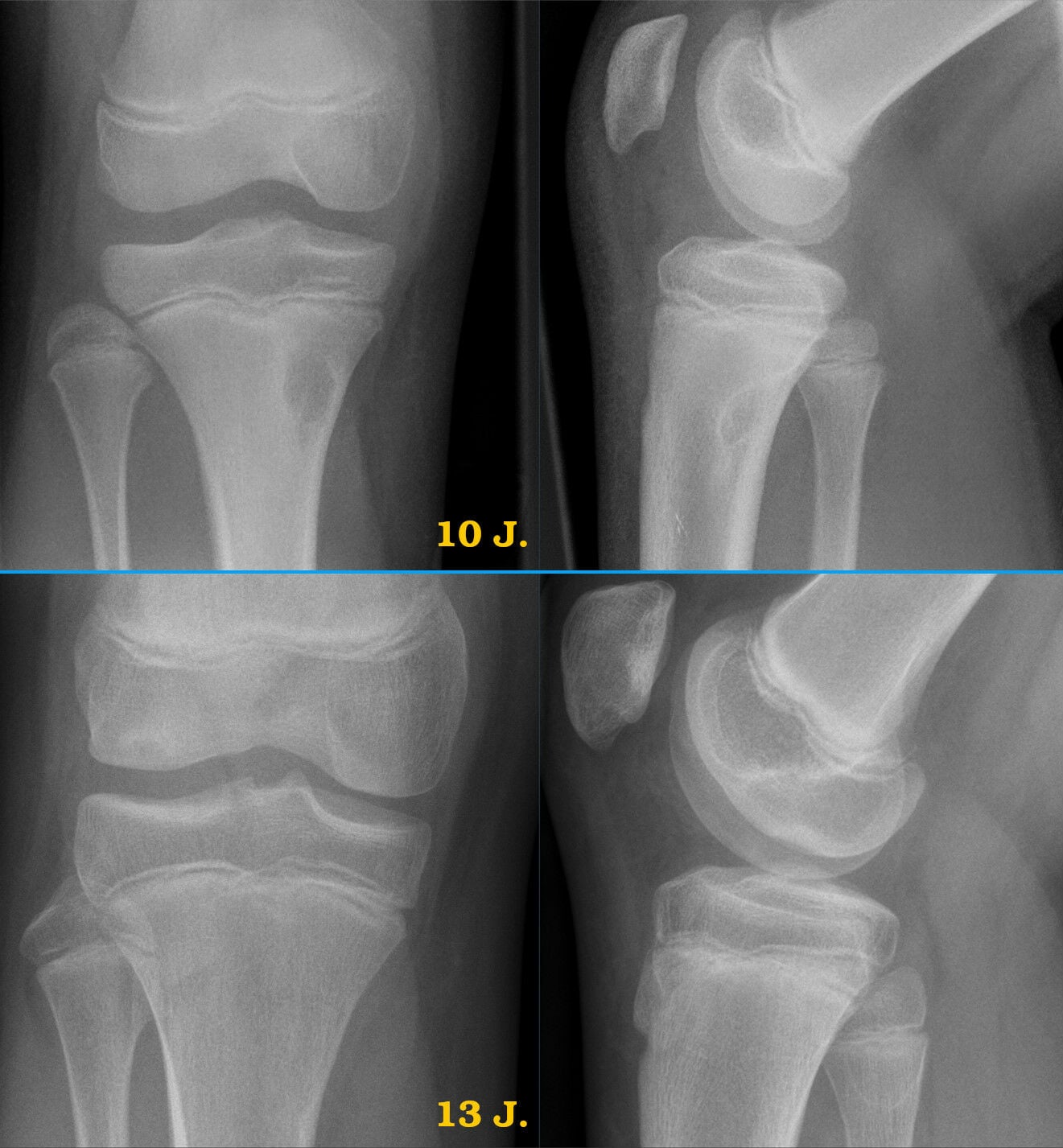Knee radiographs of the same non-ossifying fibroma at ages 10 and 13 showing spontaneous regression and migration away from the physis.