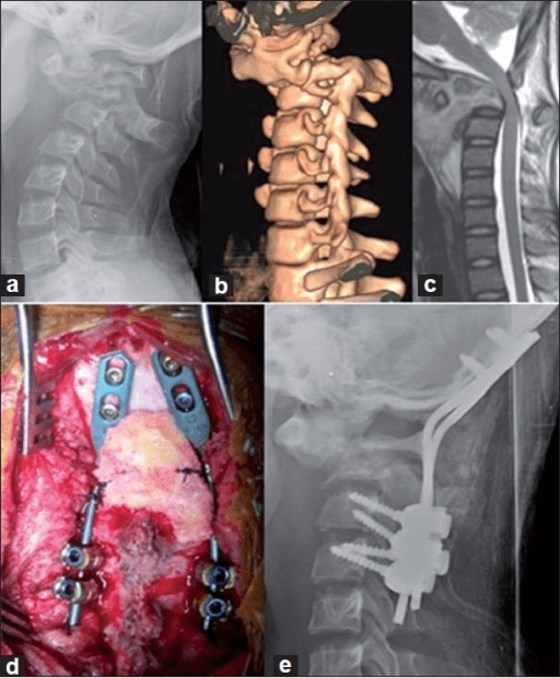 Composite of lateral radiograph, 3D CT, MRI and intra-operative images of atlanto-axial tuberculosis in a child