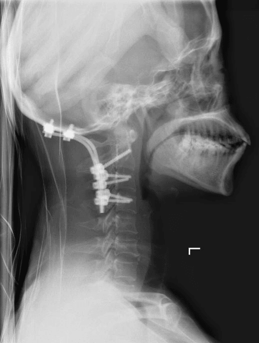 Postoperative lateral cervical spine radiograph
