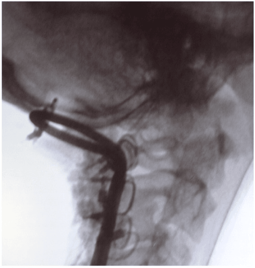 Immediate postoperative radiographs showing occipitocervical fusion construct