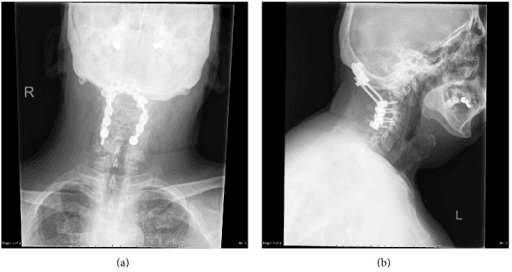 AP and lateral cervical spine X-rays showing occipitocervical instrumentation