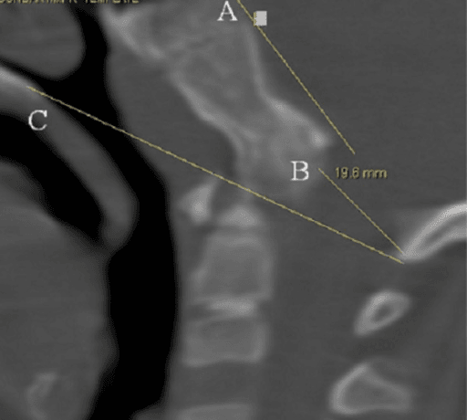 Sagittal 3D CT of craniocervical junction with Wachenheim clivus line drawn along the posterior clivus