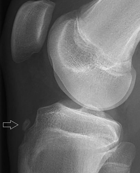 Lateral knee radiograph of an adolescent showing an avulsion fracture of the tibial tuberosity.