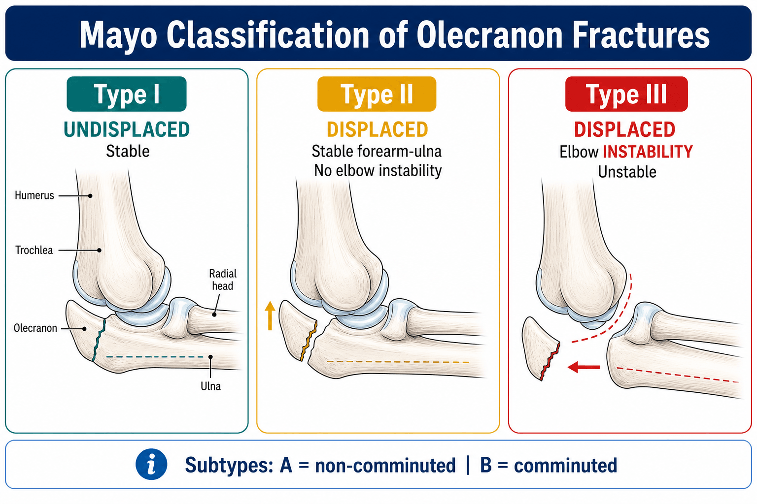 Mayo classification of olecranon fractures