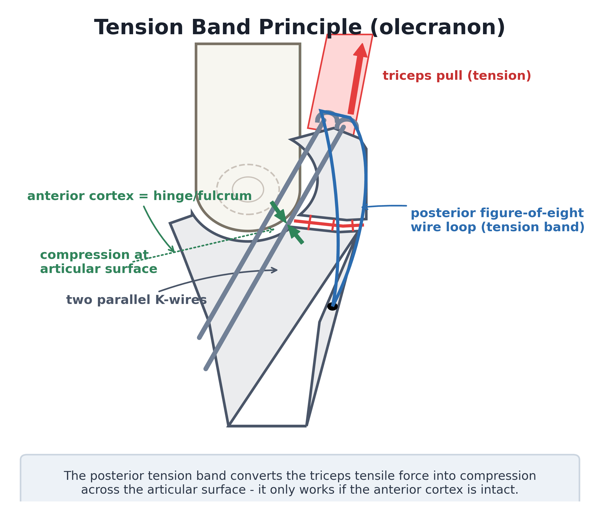 Diagram of the tension band principle in olecranon fixation showing triceps tension converted to articular compression