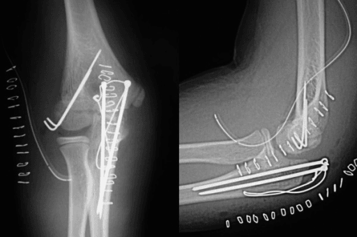 Post-operative AP and lateral X-rays showing tension band wire fixation for olecranon fracture